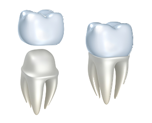 All Porcelain Crowns & Bridges