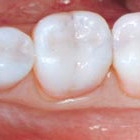 Composite Bonding (Tooth Colored Fillings)